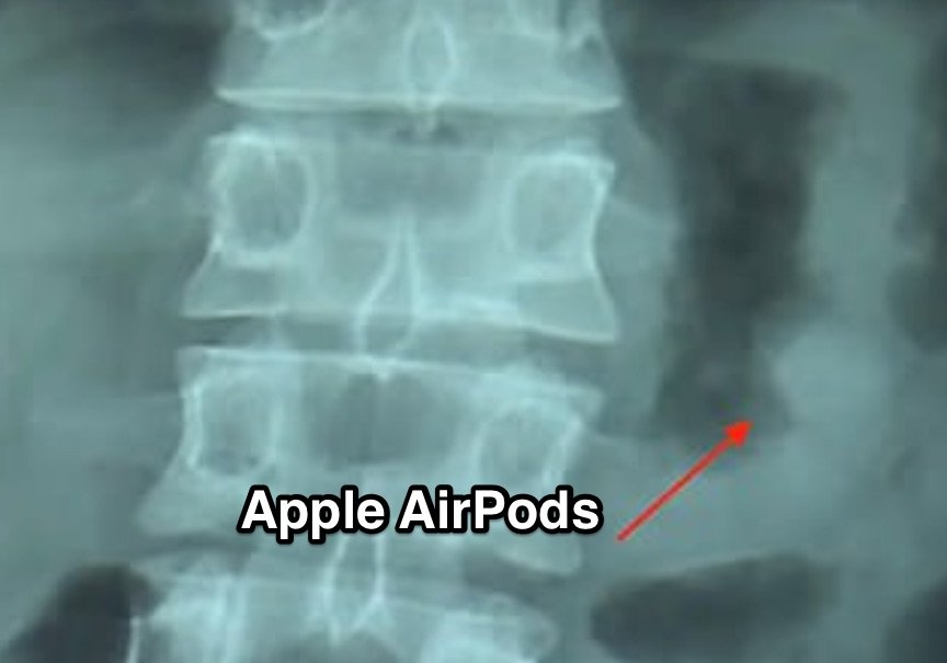 Apple Magie: versehentlich verschluckte AirPods funktionieren im Magen (und nach der Ausscheidung) 9